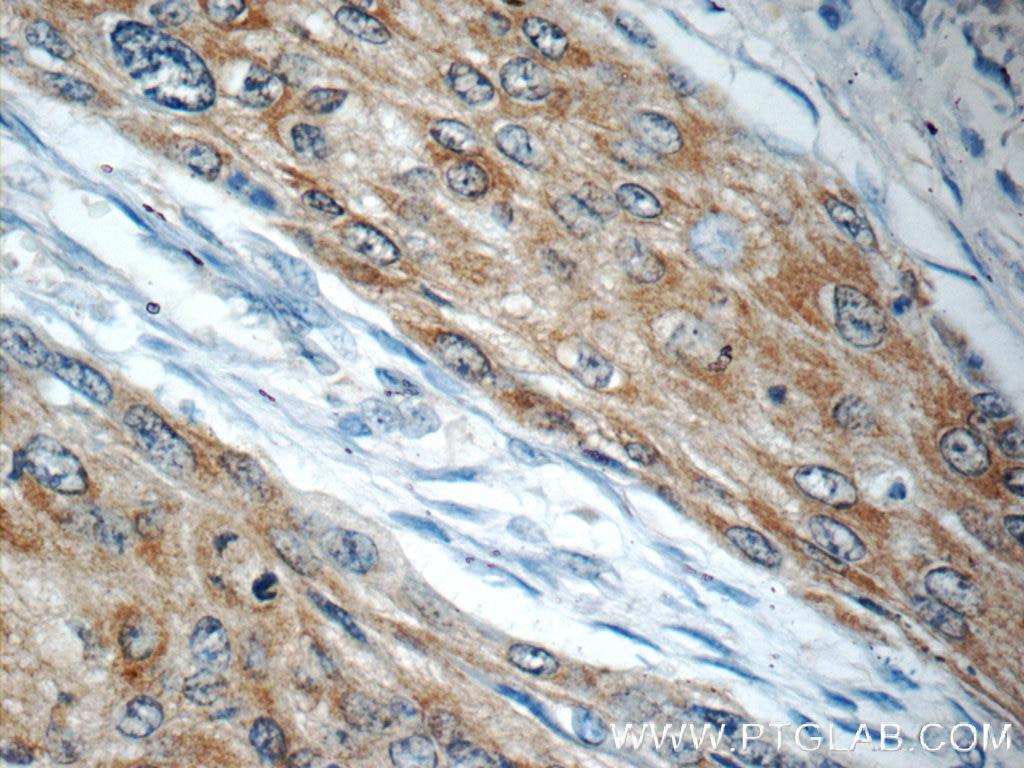 IHC staining of human oesophagus cancer using 13373-1-AP