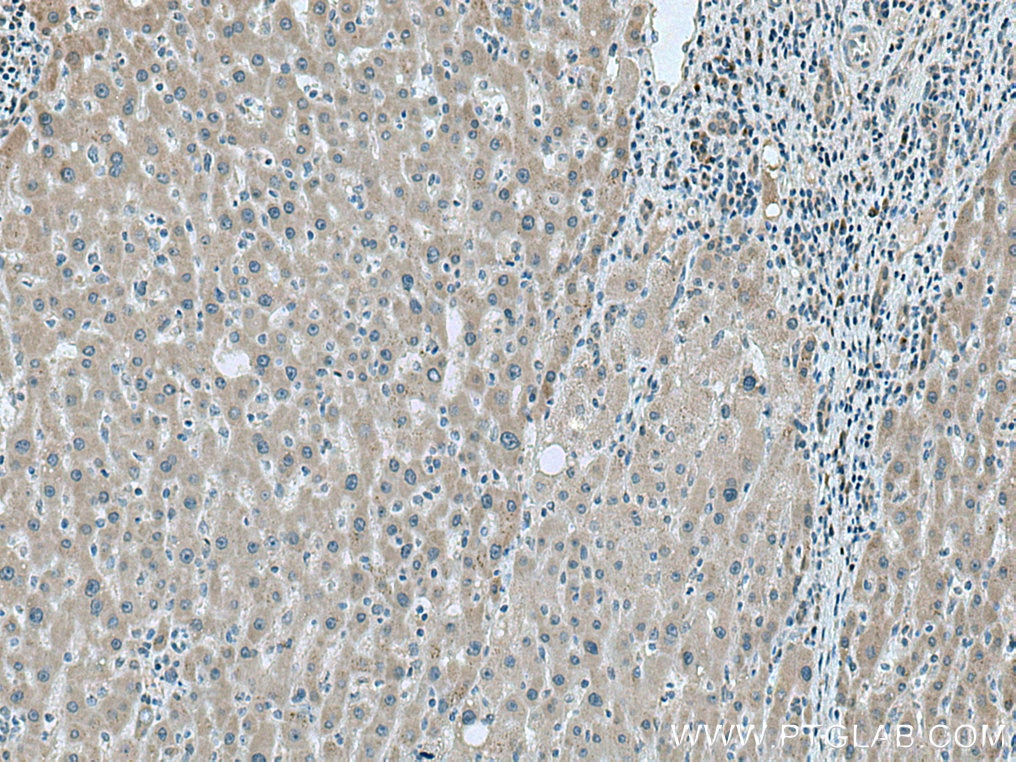 IHC staining of human liver cancer using 16146-1-AP