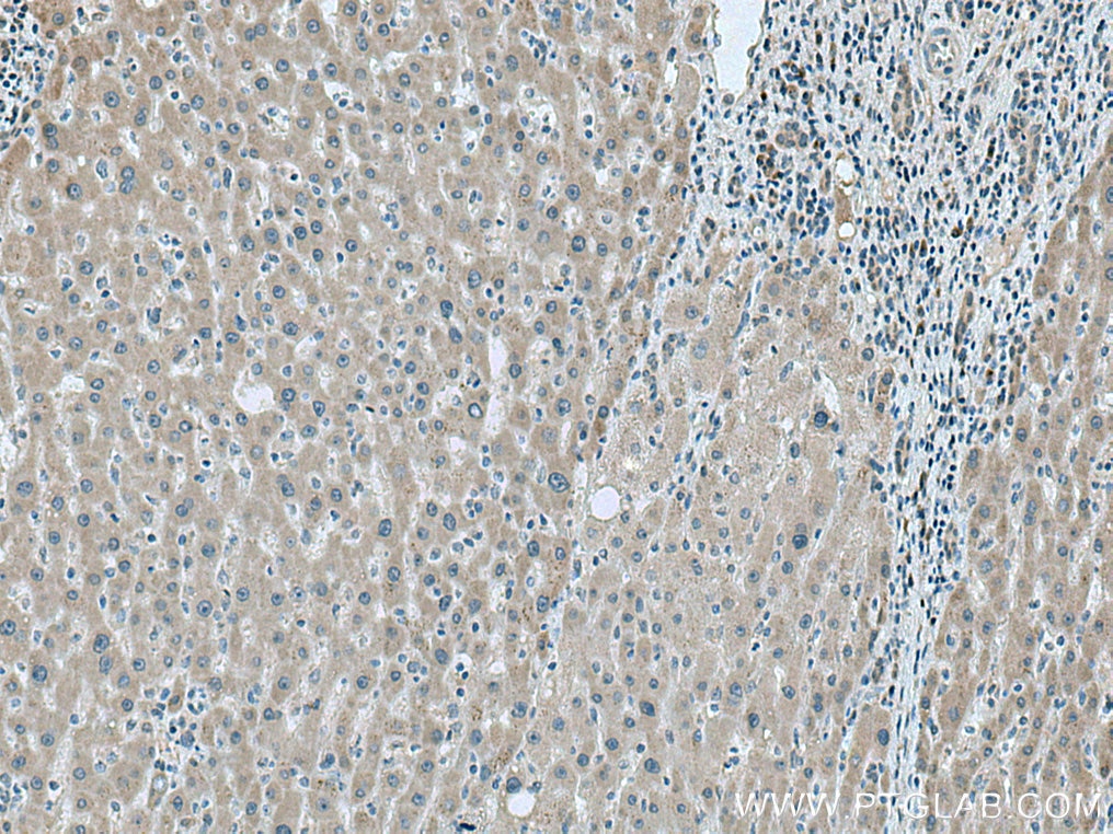 Immunohistochemistry (IHC) staining of human liver cancer tissue using LYPLAL1 Polyclonal antibody (16146-1-AP)