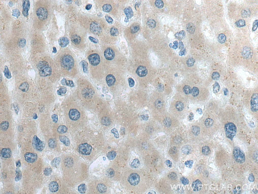 Immunohistochemistry (IHC) staining of human liver cancer tissue using LYPLAL1 Polyclonal antibody (16146-1-AP)