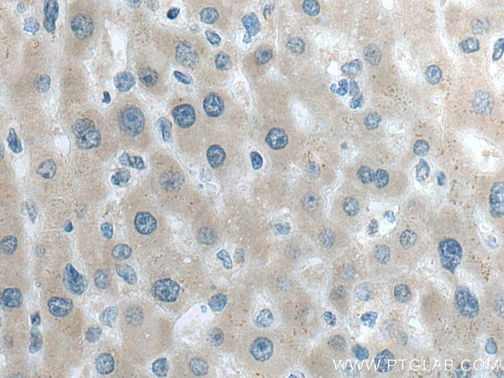 Immunohistochemistry (IHC) staining of human liver cancer tissue using LYPLAL1 Polyclonal antibody (16146-1-AP)