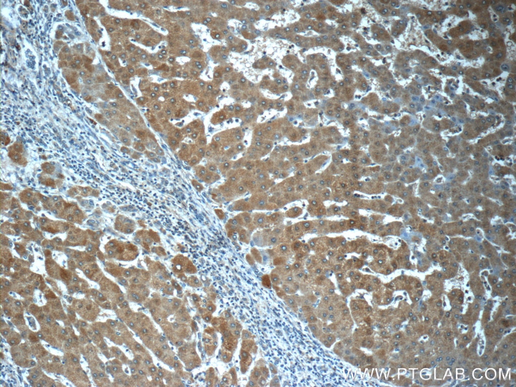 Immunohistochemistry (IHC) staining of human hepatocirrhosis tissue using LYRM7 Polyclonal antibody (23833-1-AP)