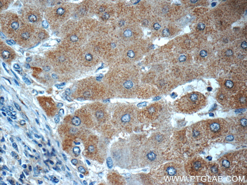 Immunohistochemistry (IHC) staining of human hepatocirrhosis tissue using LYRM7 Polyclonal antibody (23833-1-AP)
