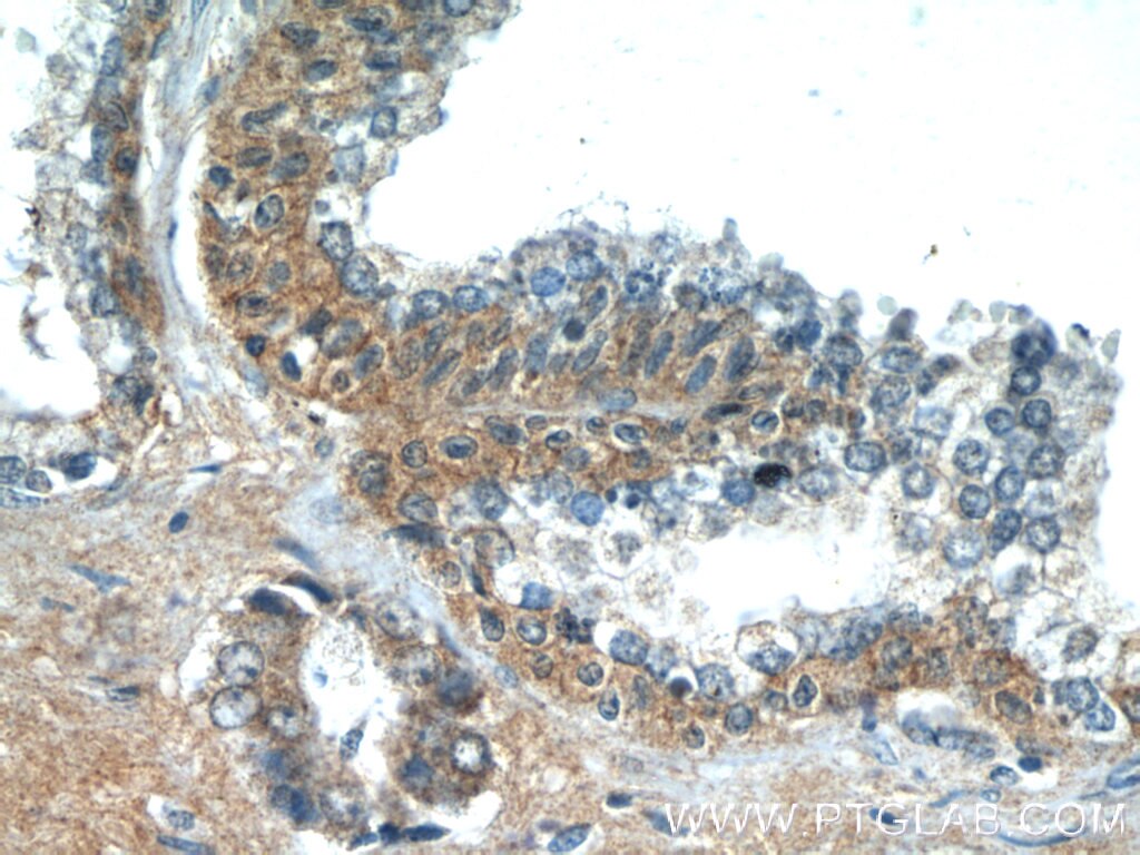 Immunohistochemistry (IHC) staining of human prostate hyperplasia tissue using LZTS2 Polyclonal antibody (15677-1-AP)