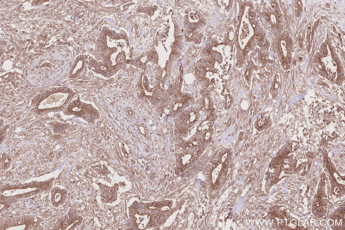 Immunohistochemistry (IHC) staining of human rectal cancer tissue using LZTS2 Polyclonal antibody (15677-1-AP)
