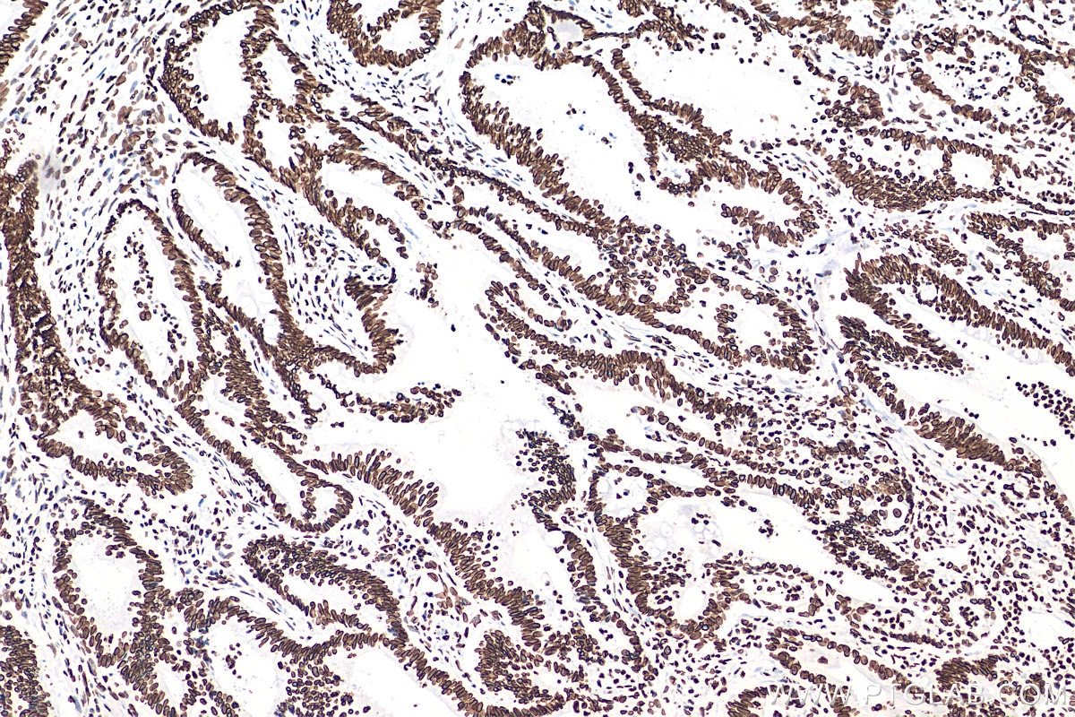 Immunohistochemistry (IHC) staining of human colon cancer tissue using Lamin B1 Recombinant antibody (80906-1-RR)