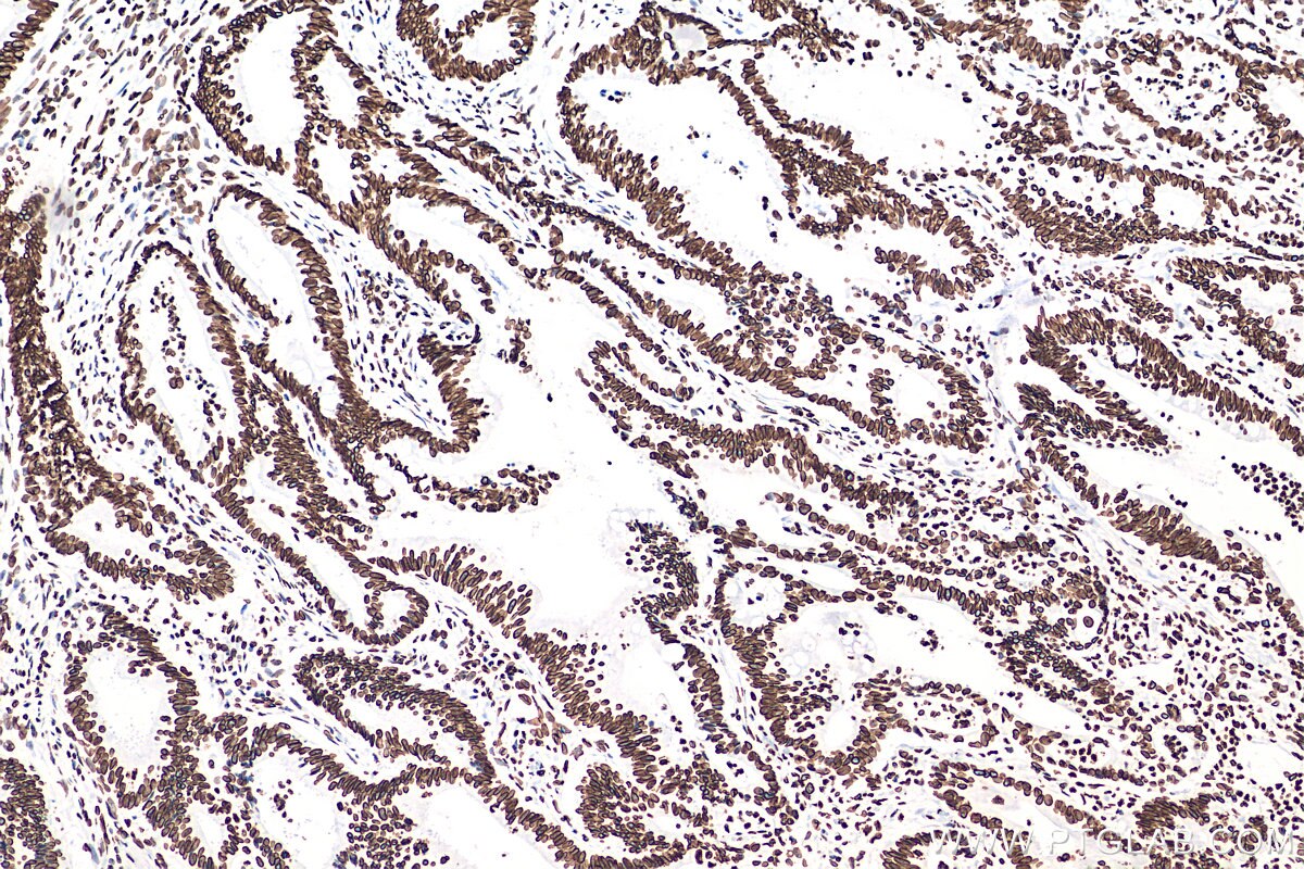 IHC staining of human colon cancer using 80906-1-RR