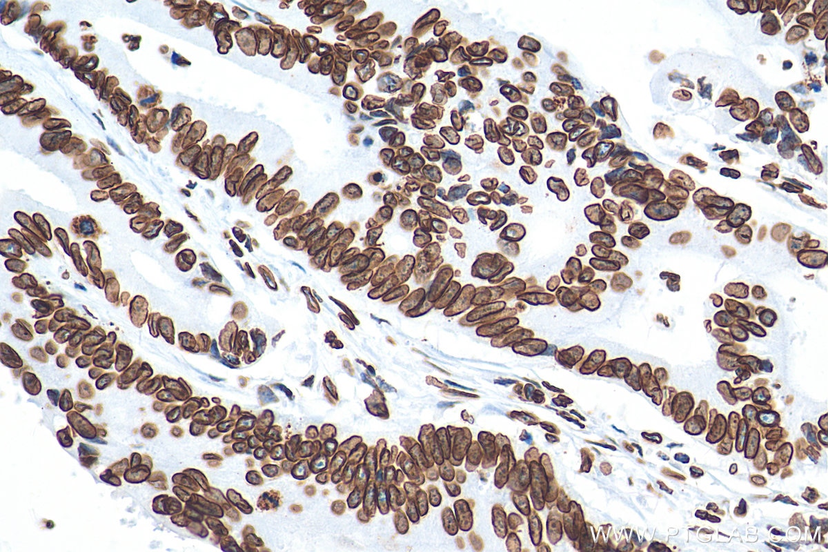 Immunohistochemistry (IHC) staining of human colon cancer tissue using Lamin B1 Recombinant antibody (80906-1-RR)