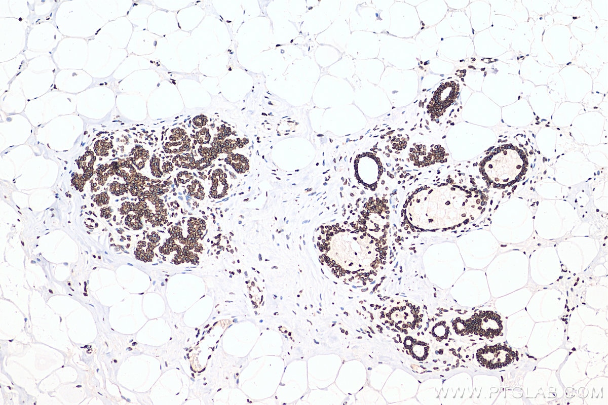 Immunohistochemistry (IHC) staining of human breast cancer tissue using Lamin B1 Recombinant antibody (80906-1-RR)