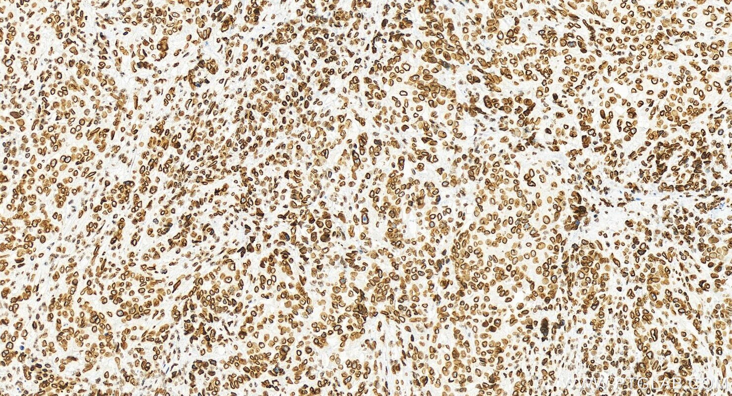 Immunohistochemical analysis of paraffin-embedded stomach cancer slide using 82801-4-RR (Lamin B2 antibody) at dilution of 1:2000 (under 20x lens). Heat mediated antigen retrieval with Tris-EDTA buffer (pH 9.0). This data was developed using the same antibody clone with 82801-4-PBS in a different storage buffer formulation. Immunohistochemistry (IHC) staining of human stomach cancer tissue using Lamin B2 Recombinant monoclonal antibody (82801-4-RR)