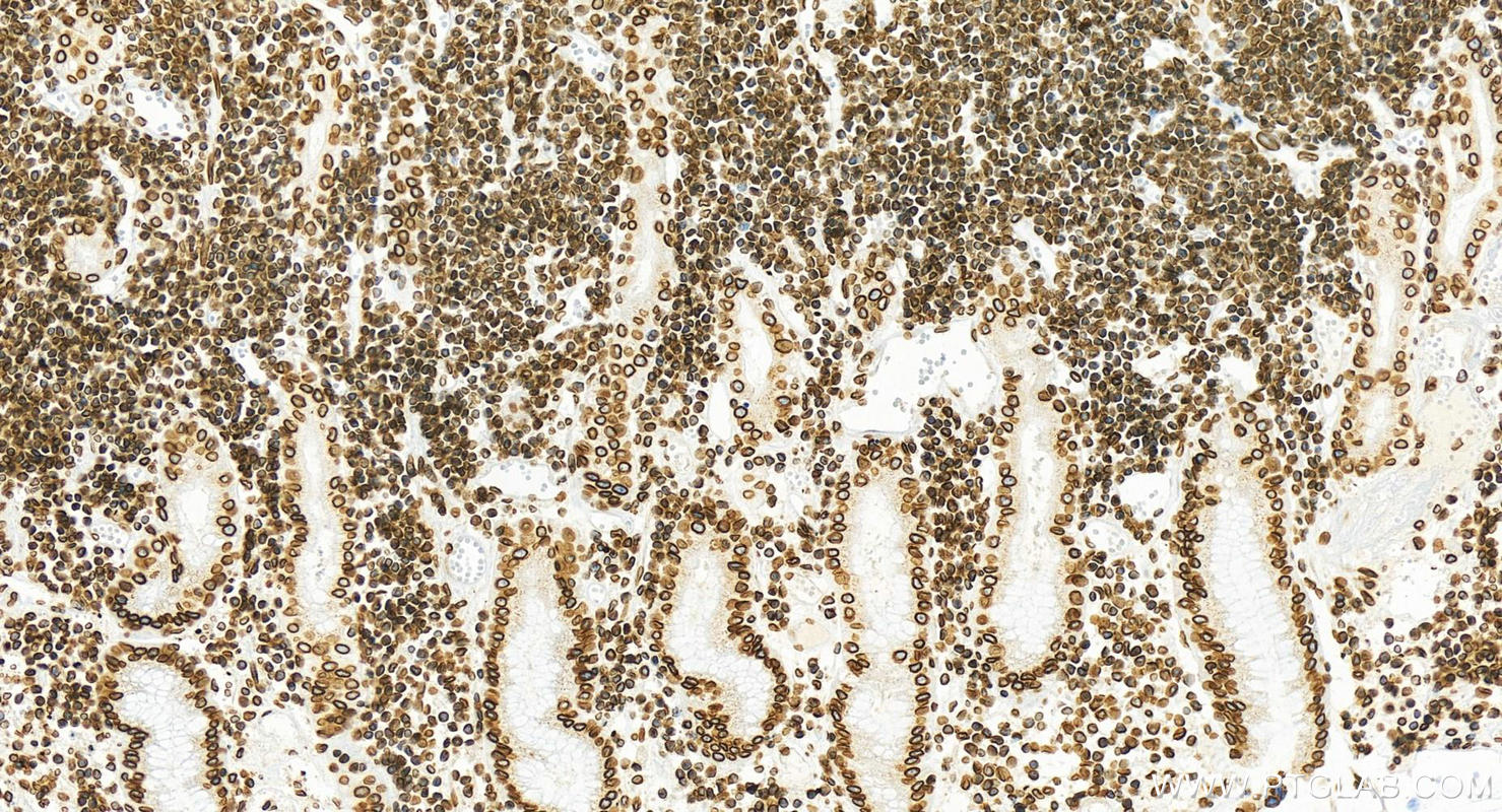 Immunohistochemical analysis of paraffin-embedded stomach cancer slide using 82801-4-RR (Lamin B2 antibody) at dilution of 1:2000 (under 20x lens). Heat mediated antigen retrieval with Tris-EDTA buffer (pH 9.0). This data was developed using the same antibody clone with 82801-4-PBS in a different storage buffer formulation. Immunohistochemistry (IHC) staining of human stomach cancer tissue using Lamin B2 Recombinant monoclonal antibody (82801-4-RR)