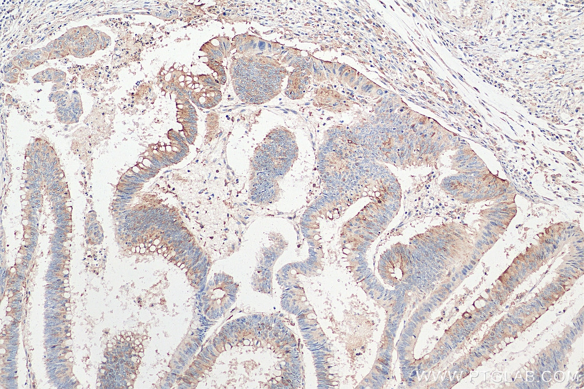 Immunohistochemistry (IHC) staining of human colon cancer tissue using Lin28B-specific Polyclonal antibody (16178-1-AP)