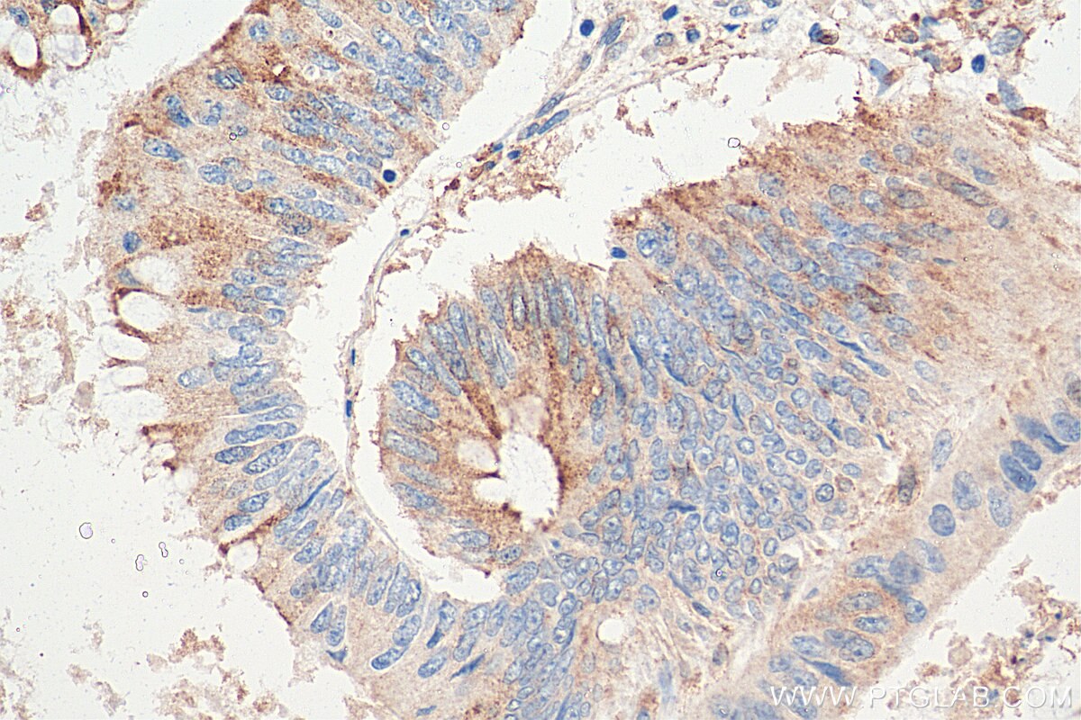 Immunohistochemistry (IHC) staining of human colon cancer tissue using Lin28B-specific Polyclonal antibody (16178-1-AP)