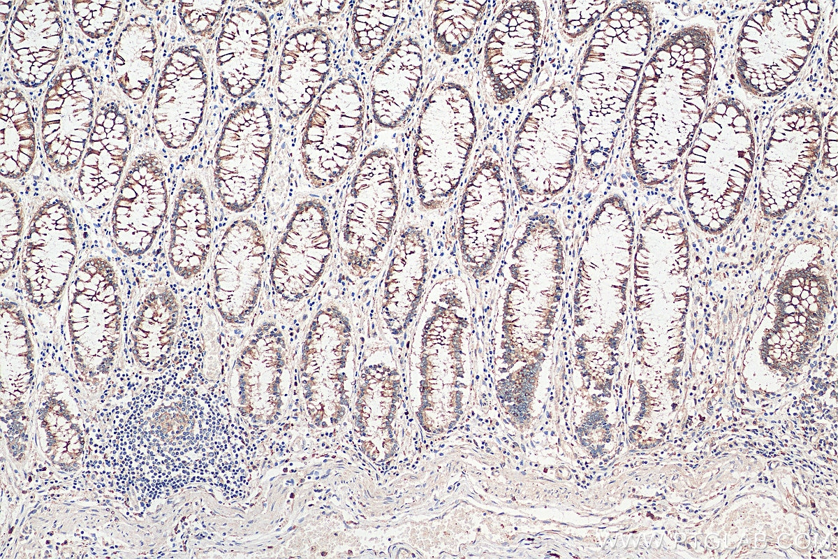 Immunohistochemistry (IHC) staining of human colon cancer tissue using Lin28B-specific Polyclonal antibody (16178-1-AP)