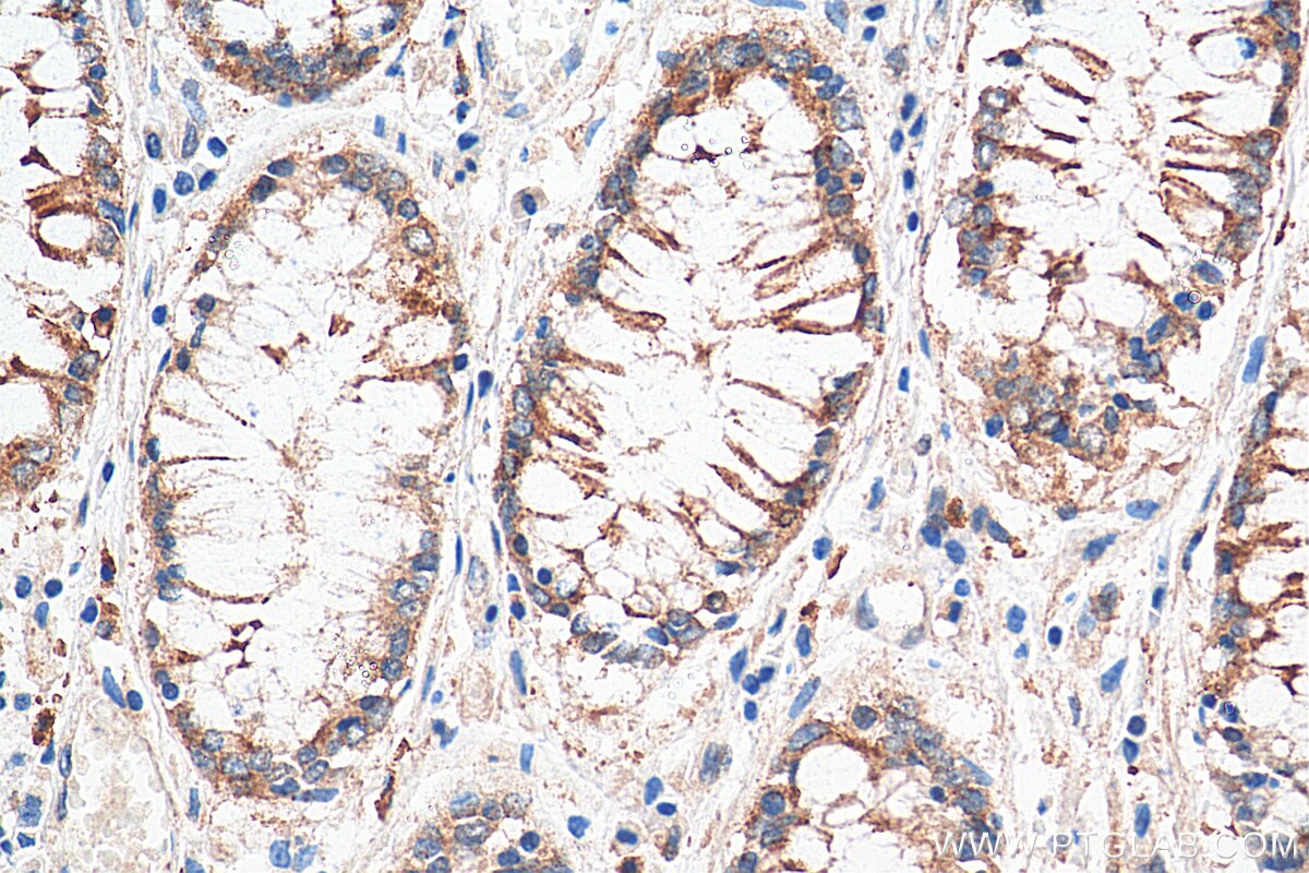 Immunohistochemistry (IHC) staining of human colon cancer tissue using Lin28B-specific Polyclonal antibody (16178-1-AP)