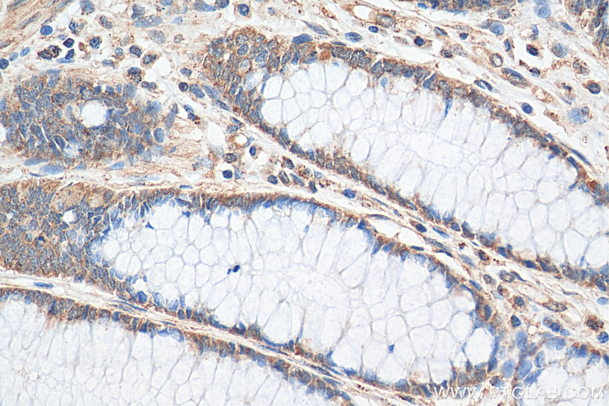 Immunohistochemistry (IHC) staining of human colon cancer tissue using Lin28B-specific Polyclonal antibody (16178-1-AP)