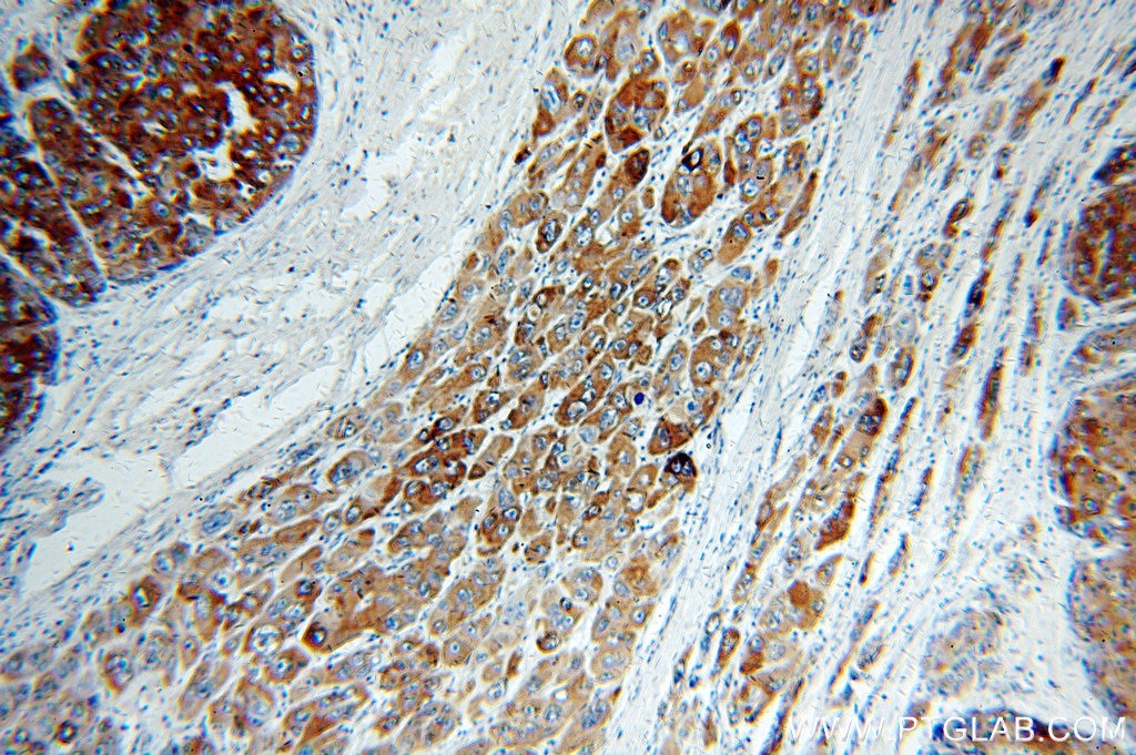 IHC staining of human liver cancer using 16178-1-AP