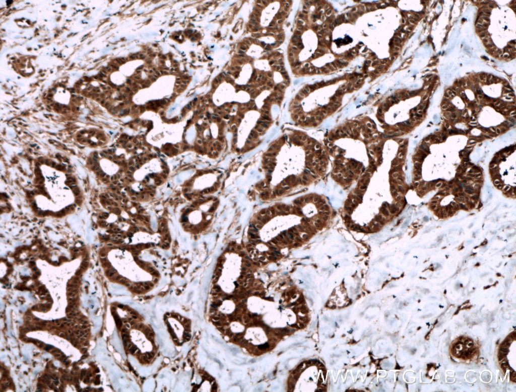 Immunohistochemistry (IHC) staining of human breast cancer tissue using Livin Polyclonal antibody (27543-1-AP)