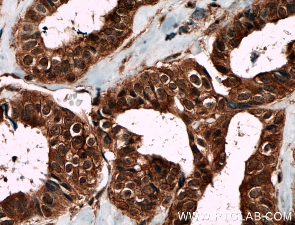 Immunohistochemistry (IHC) staining of human breast cancer tissue using Livin Polyclonal antibody (27543-1-AP)