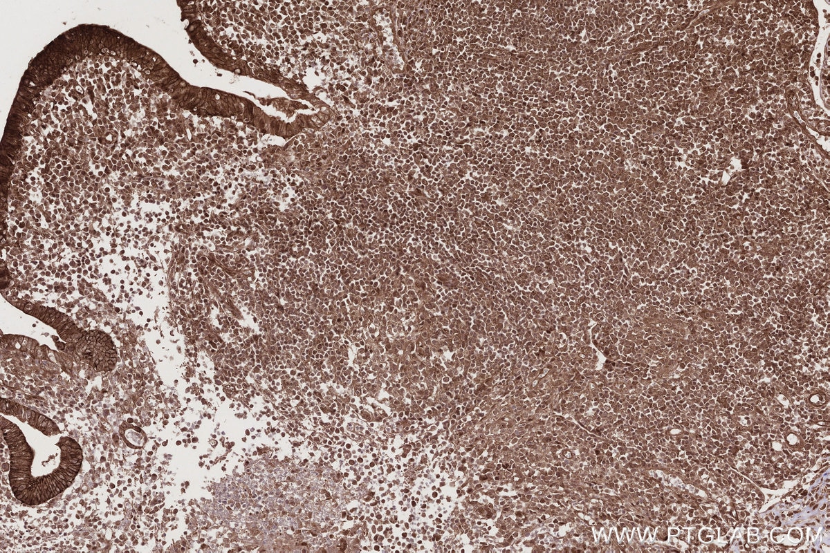 Immunohistochemistry (IHC) staining of human appendicitis tissue using Livin Polyclonal antibody (27543-1-AP)