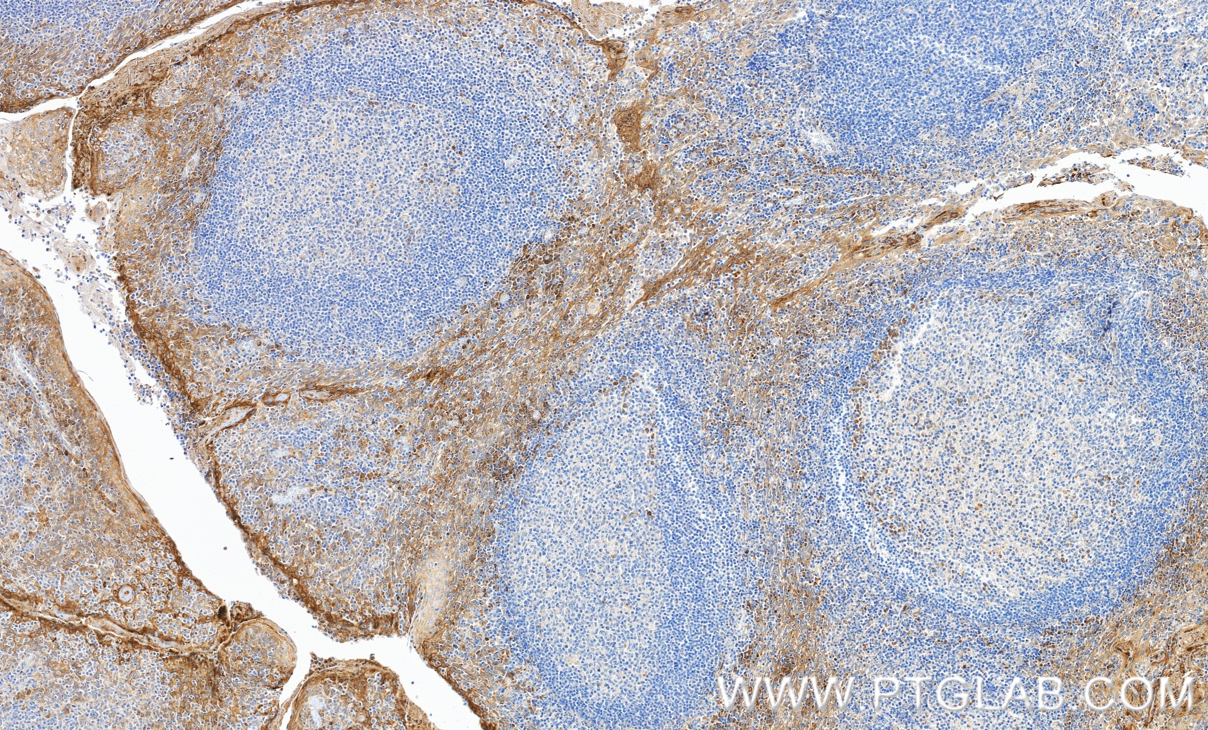 IHC staining of human tonsillitis using 98756-2-RR Immunohistochemistry (IHC) staining of human tonsillitis tissue using Anti-Human M-CSF Rabbit Recombinant Antibody (98756-2-RR)