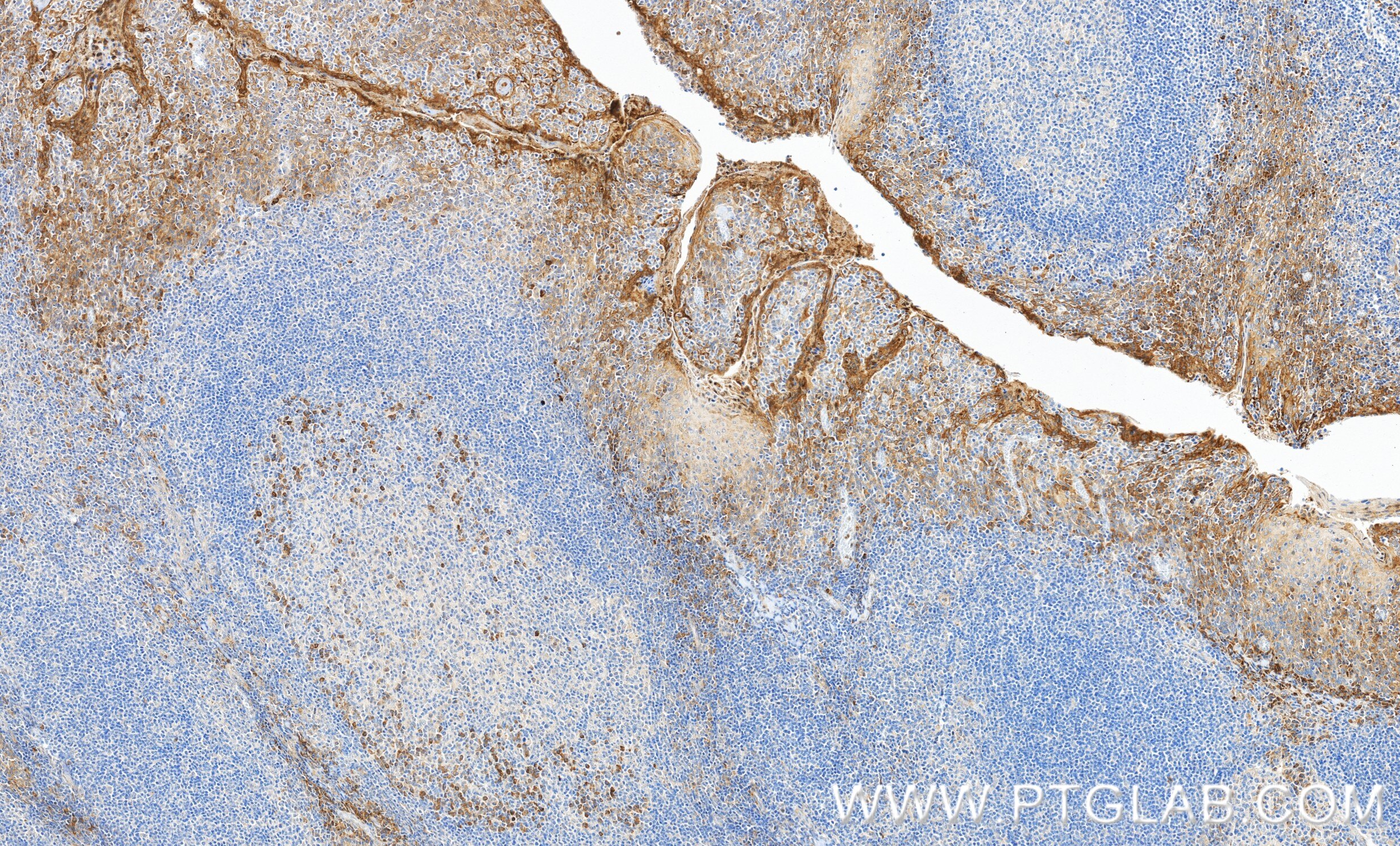 IHC staining of human tonsillitis using 98756-2-RR Immunohistochemistry (IHC) staining of human tonsillitis tissue using Anti-Human M-CSF Rabbit Recombinant Antibody (98756-2-RR)
