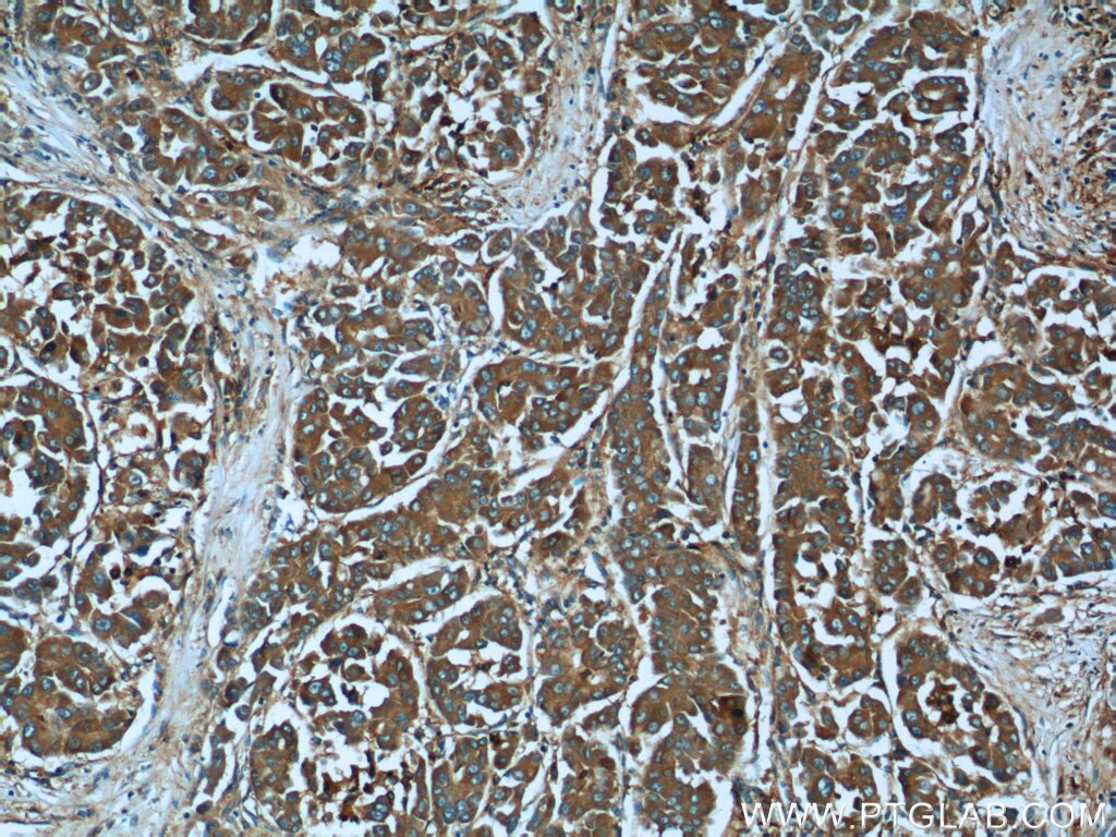 IHC staining of human liver cancer using 21970-1-AP