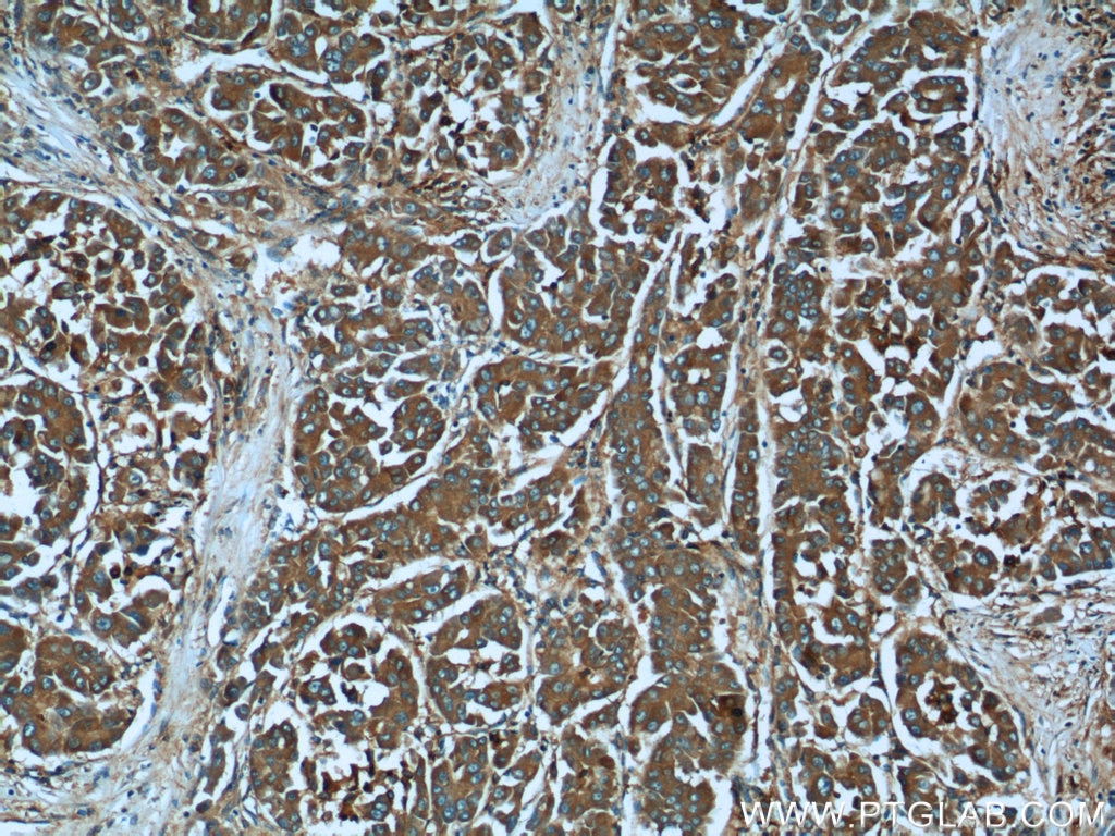 Immunohistochemistry (IHC) staining of human liver cancer tissue using MACC1 Polyclonal antibody (21970-1-AP)