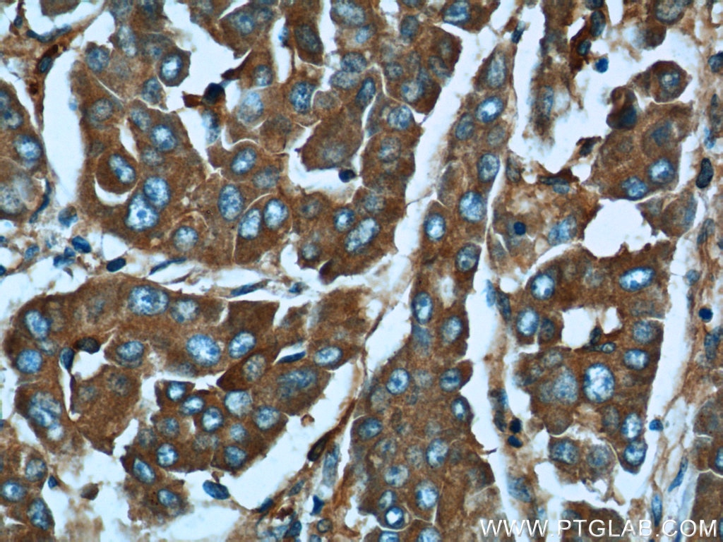 Immunohistochemistry (IHC) staining of human liver cancer tissue using MACC1 Polyclonal antibody (21970-1-AP)