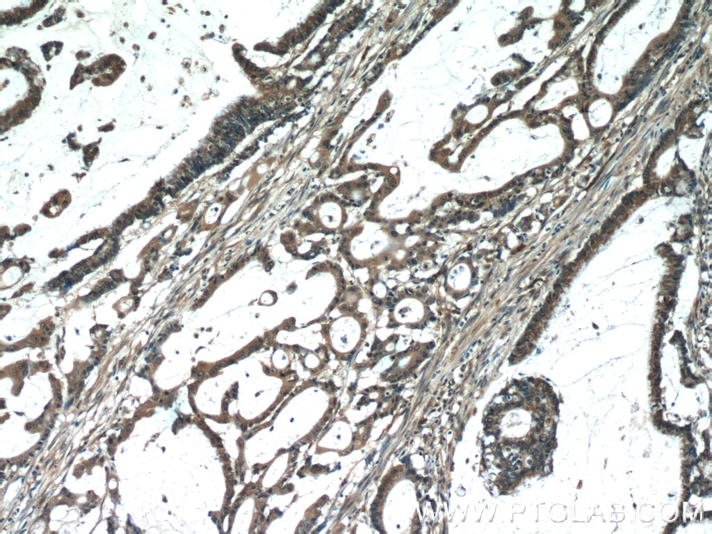 Immunohistochemistry (IHC) staining of human colon cancer tissue using MACC1 Polyclonal antibody (21970-1-AP)