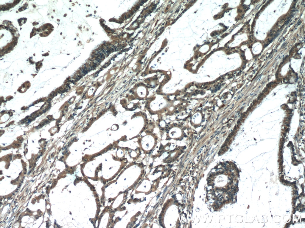 Immunohistochemistry (IHC) staining of human colon cancer tissue using MACC1 Polyclonal antibody (21970-1-AP)