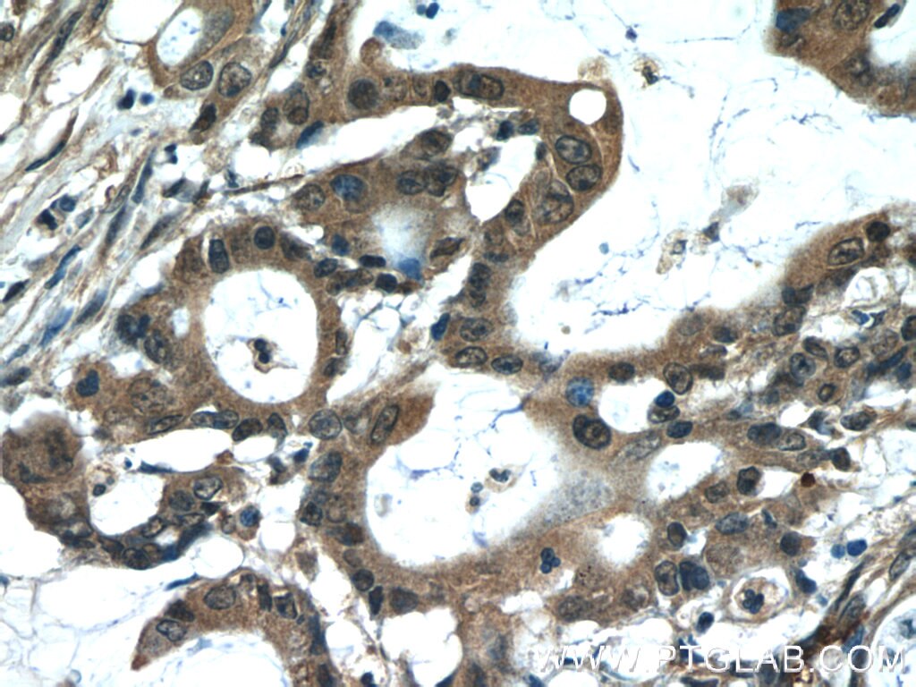 Immunohistochemistry (IHC) staining of human colon cancer tissue using MACC1 Polyclonal antibody (21970-1-AP)