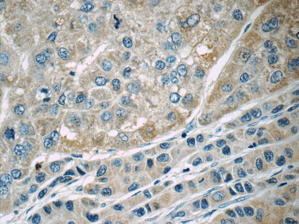 Immunohistochemistry (IHC) staining of human liver cancer tissue using MACC1 Polyclonal antibody (21970-1-AP)