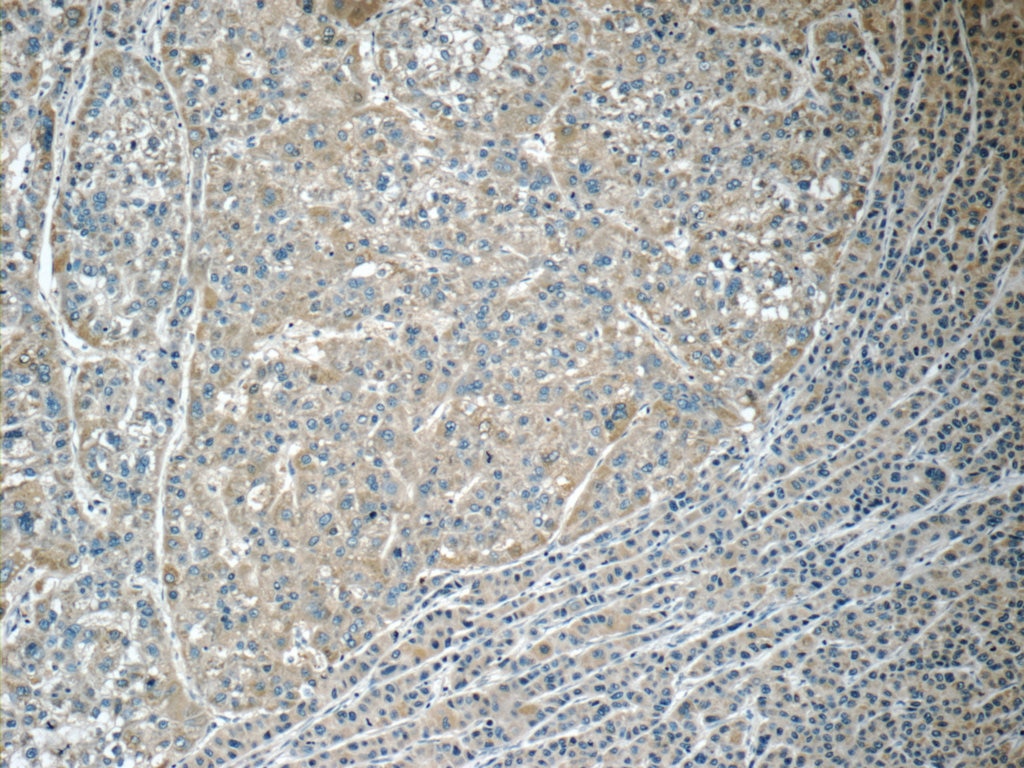 Immunohistochemistry (IHC) staining of human liver cancer tissue using MACC1 Polyclonal antibody (21970-1-AP)