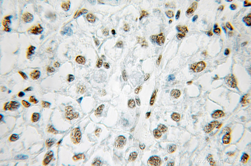 IHC staining of human liver cancer using 10337-1-AP
