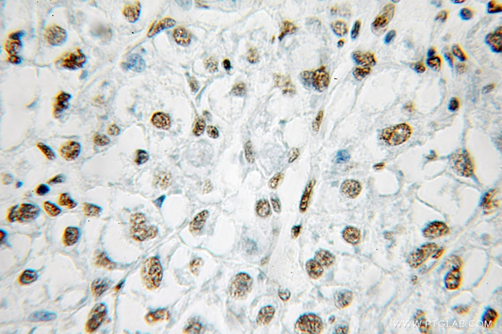 Immunohistochemistry (IHC) staining of human liver cancer tissue using MAD2L1 Polyclonal antibody (10337-1-AP)