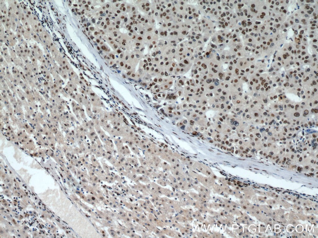 Immunohistochemistry (IHC) staining of human liver cancer tissue using MAD2L1 Polyclonal antibody (10337-1-AP)