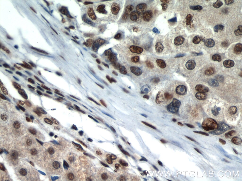 Immunohistochemistry (IHC) staining of human liver cancer tissue using MAD2L1 Polyclonal antibody (10337-1-AP)