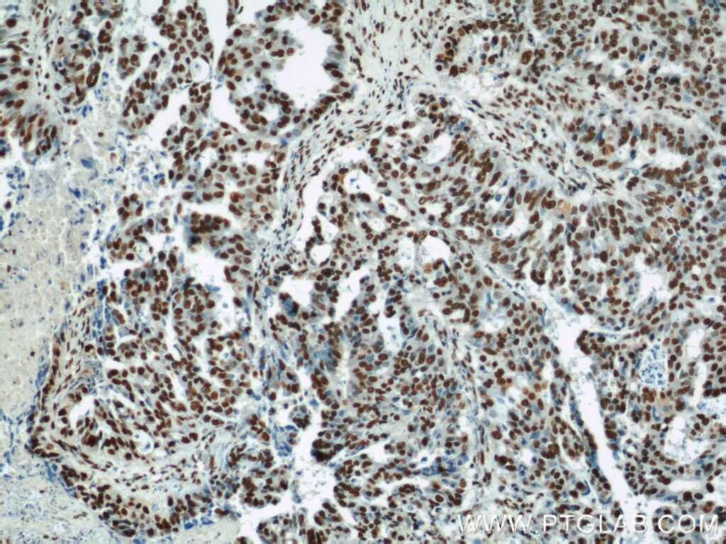 Immunohistochemistry (IHC) staining of human ovary tumor tissue using MAD2L1 Polyclonal antibody (10337-1-AP)