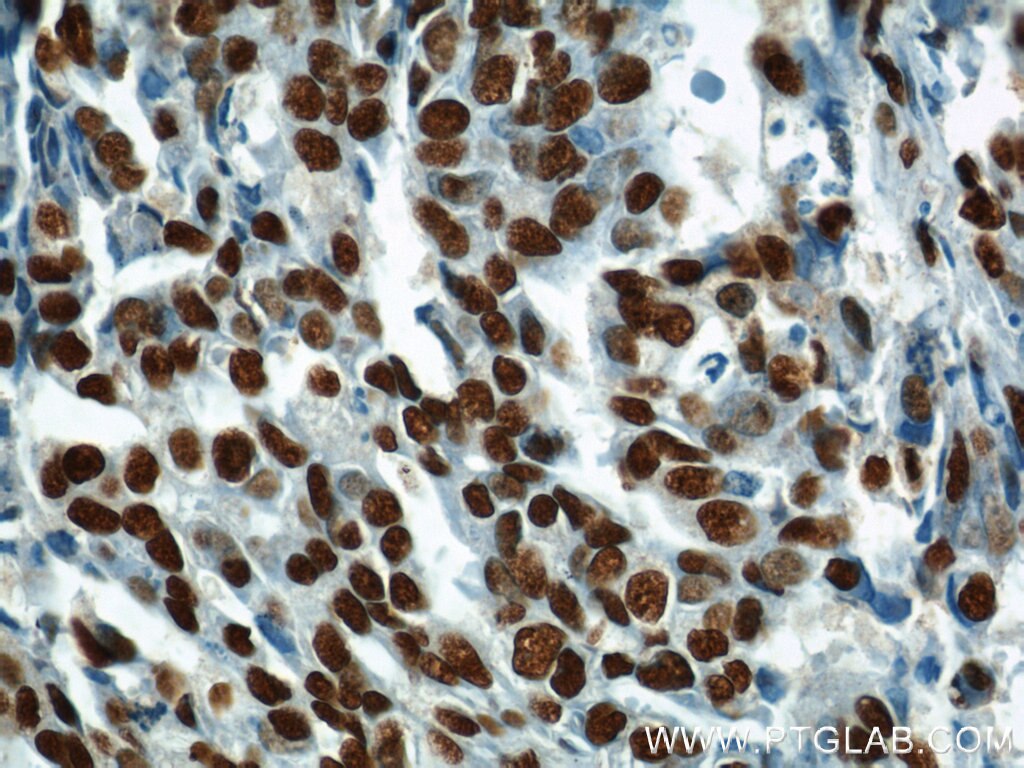 Immunohistochemistry (IHC) staining of human ovary tumor tissue using MAD2L1 Polyclonal antibody (10337-1-AP)