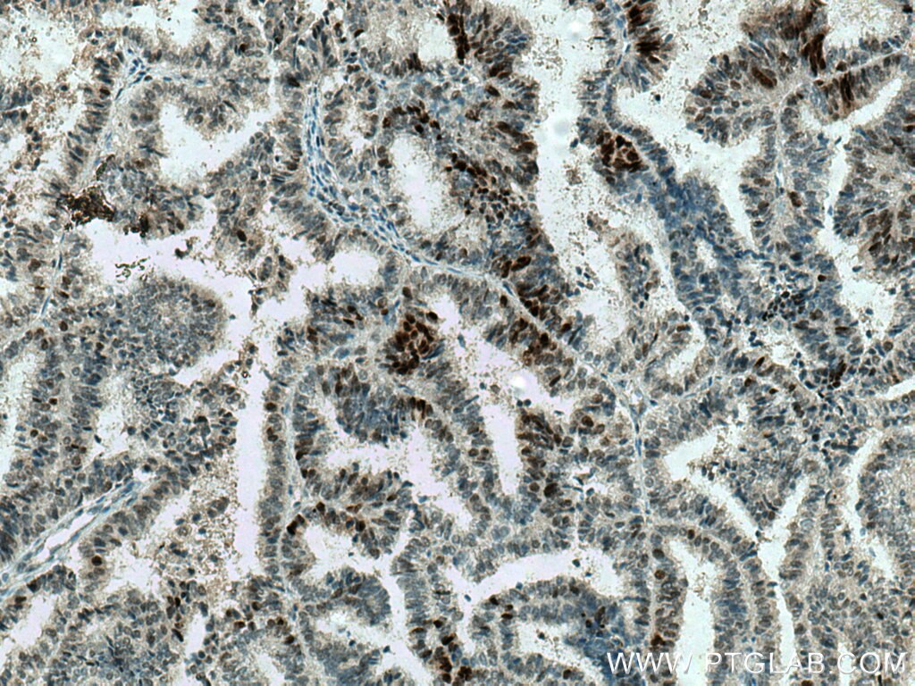 Immunohistochemistry (IHC) staining of human ovary tumor tissue using MAD2L2 Polyclonal antibody (12683-1-AP)