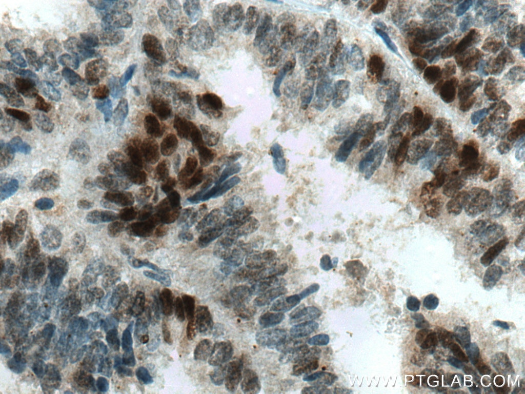 Immunohistochemistry (IHC) staining of human ovary tumor tissue using MAD2L2 Polyclonal antibody (12683-1-AP)