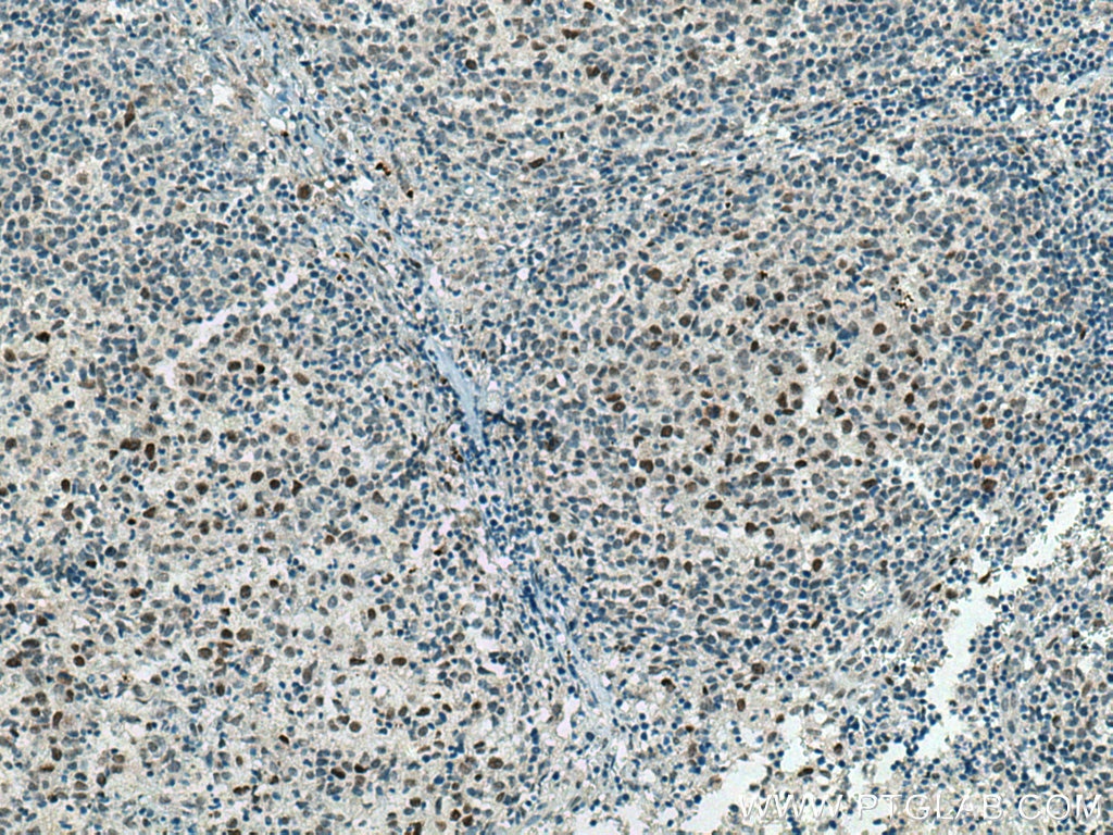 Immunohistochemistry (IHC) staining of human lymphoma tissue using MAD2L2 Polyclonal antibody (12683-1-AP)