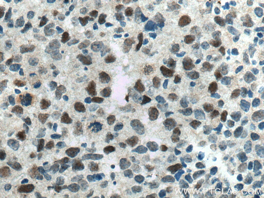 Immunohistochemistry (IHC) staining of human lymphoma tissue using MAD2L2 Polyclonal antibody (12683-1-AP)