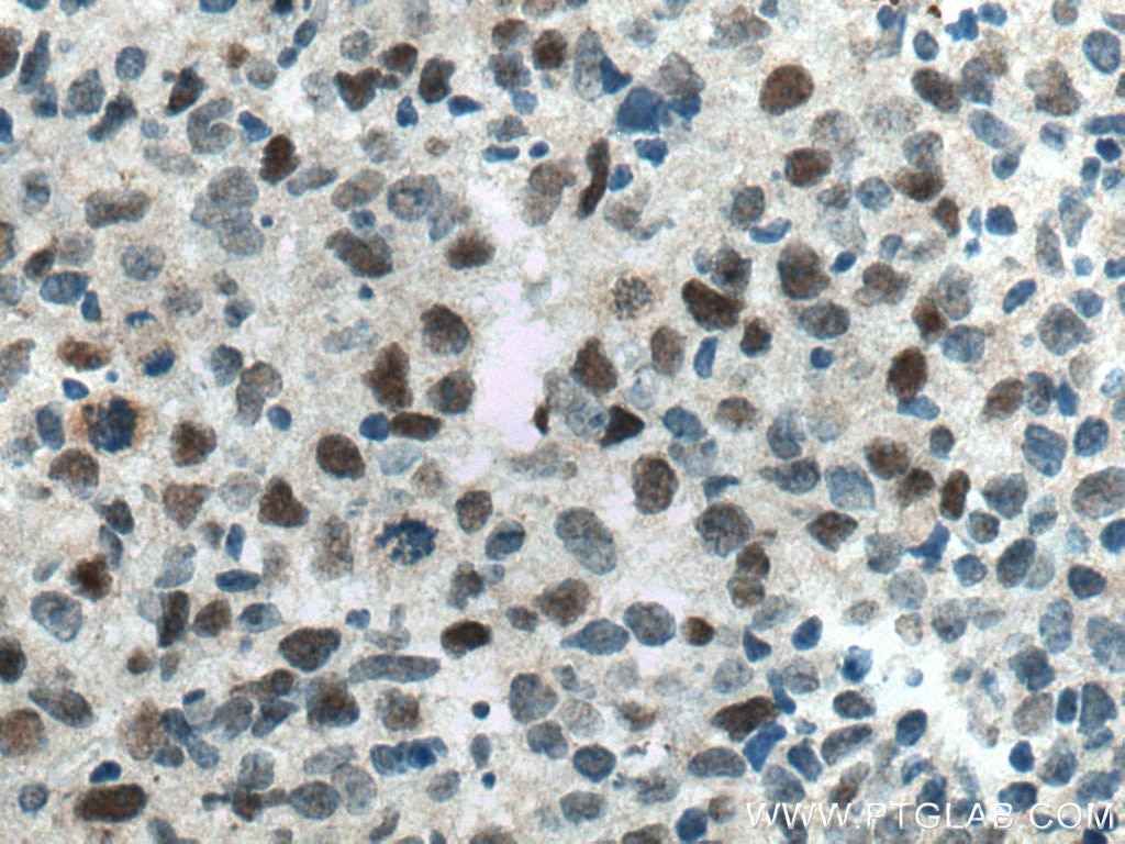 IHC staining of human lymphoma using 12683-1-AP