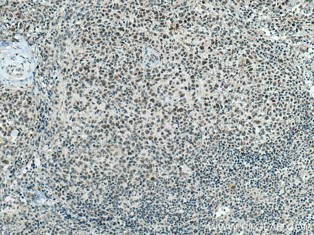 Immunohistochemistry (IHC) staining of human lymphoma tissue using MAD2L2 Monoclonal antibody (67100-1-Ig)