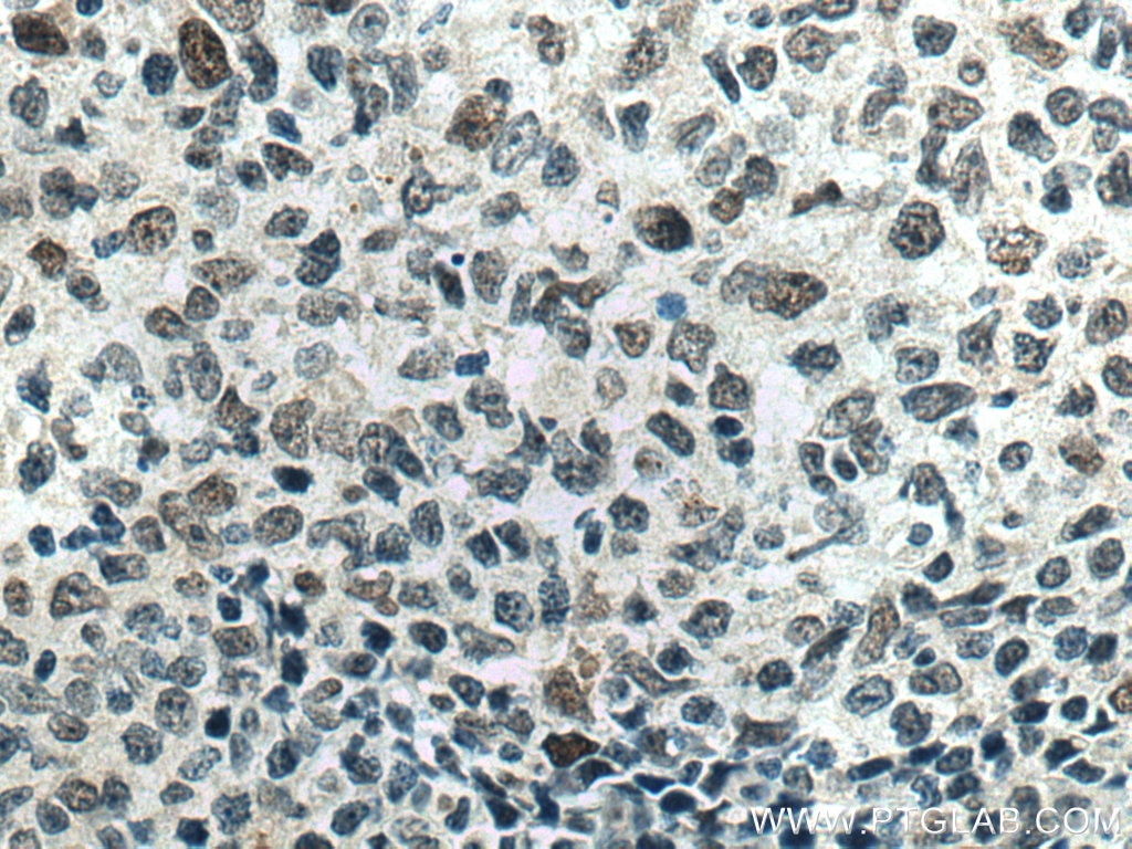 Immunohistochemistry (IHC) staining of human lymphoma tissue using MAD2L2 Monoclonal antibody (67100-1-Ig)