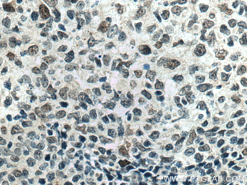 IHC staining of human lymphoma using 67100-1-Ig