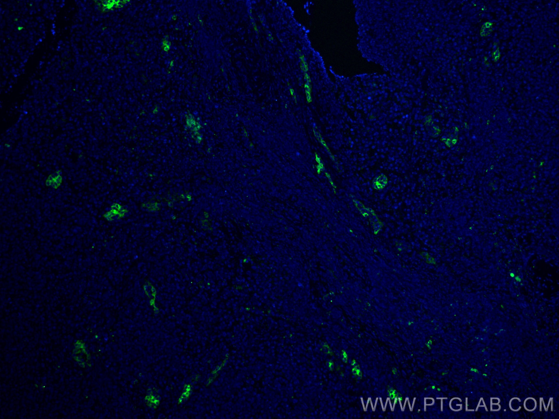 IF Staining of human tonsillitis using 66594-1-Ig