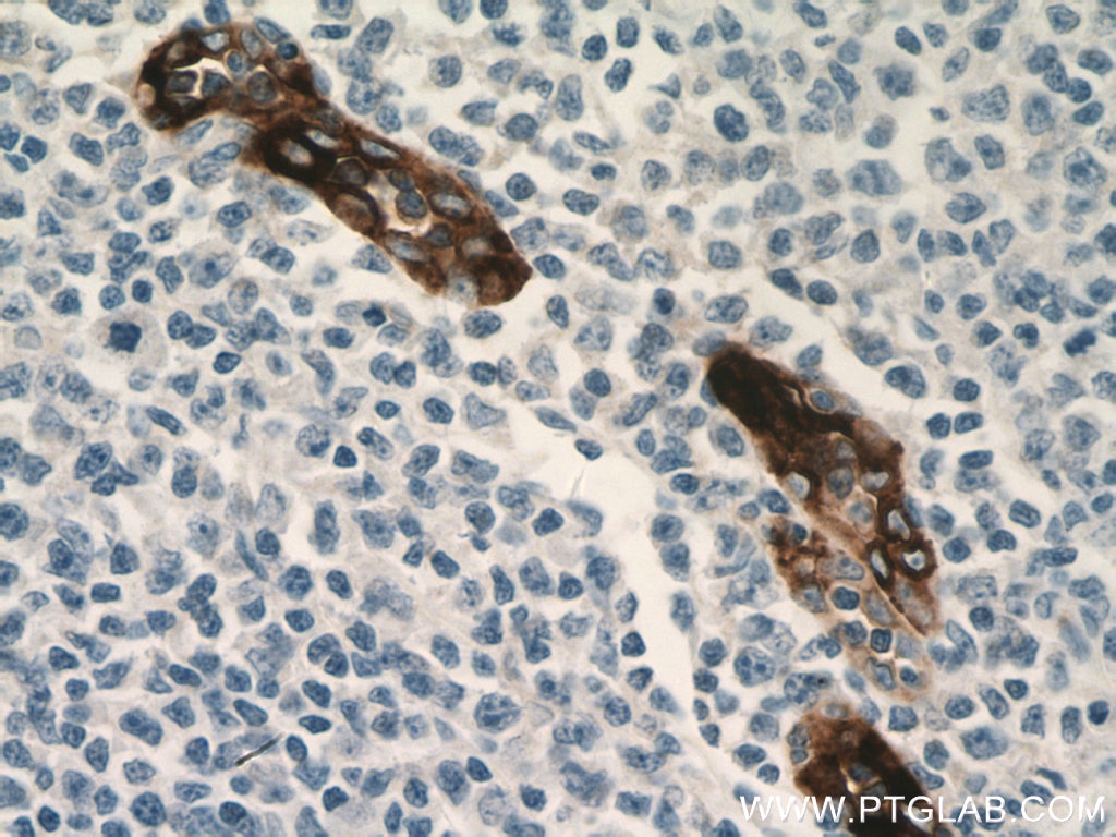 Immunohistochemistry (IHC) staining of human tonsillitis tissue using MAdCAM1 Monoclonal antibody (66594-1-Ig)